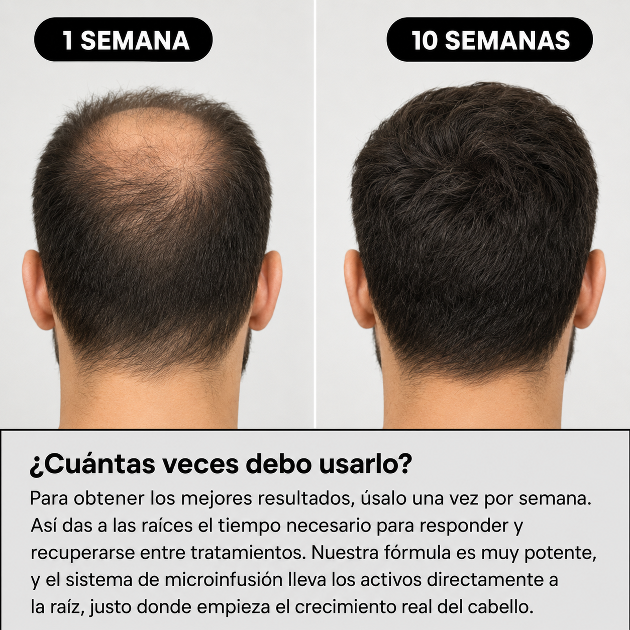 Ejemplo de mayor densidad y crecimiento capilar visible tras el uso del sistema
