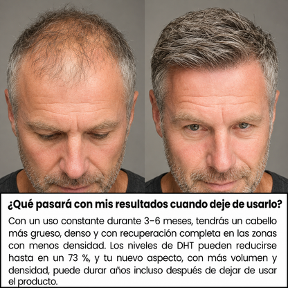 Comparativa del cabello fino sin tratamiento y tras el Sistema de Micro-Infusión Capilar